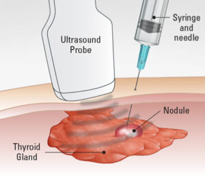 甲狀腺超音波細針穿刺