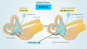 梅尼爾氏症