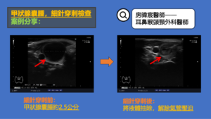甲狀腺囊腫