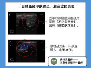 自體免疫甲狀腺炎