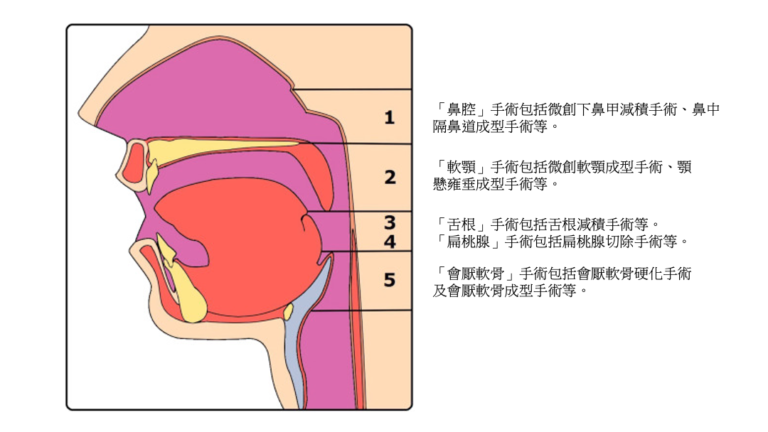 睡眠呼吸中止症的手術