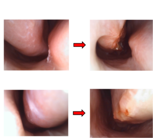 鼻塞微創手術