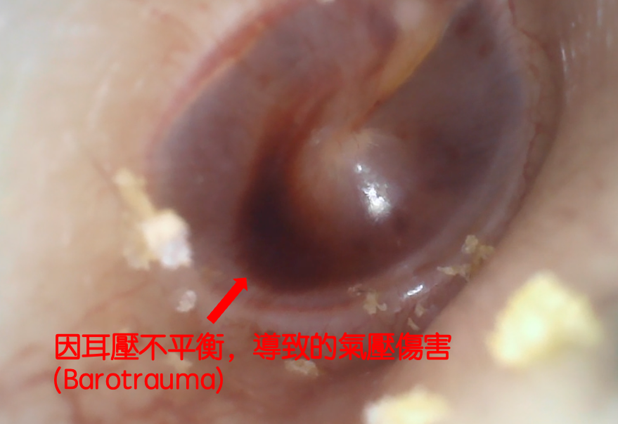 耳壓不平衡導致的氣壓傷害