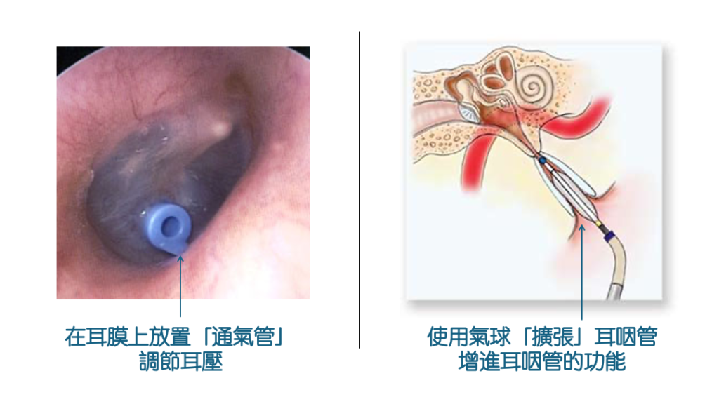 耳壓不平衡的手術治療