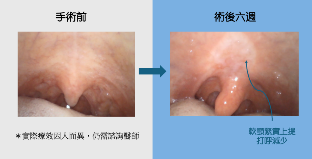 止鼾微創手術的實際案例